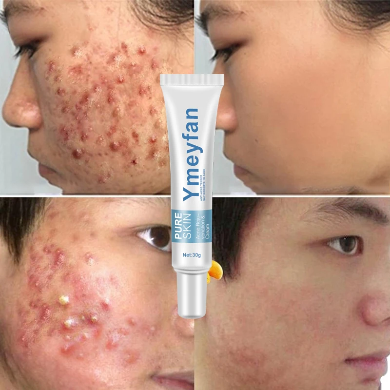 Light Print Scars Removal Face Cream Beauty Pure Skin Care Whitening Facial Moisturizing Cream anti acne cream
Light Print Scars Removal Face Cream Beauty Pure Skin Care Whitening Facial Moisturizing Cream anti acne cream