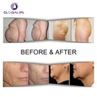 Rf Machine RF Microneedle Ultrasonic Liposuction Cavitation Machine For Sale