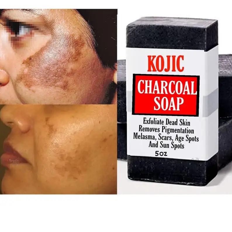 Natural Kojic Activated Soap Dark Age Spots Treatment Removal Sunburn Brighter Skin Glowing Skin Kojic Soap
Natural Kojic Activated Soap Dark Age Spots Treatment Removal Sunburn Brighter Skin Glowing Skin Kojic Soap