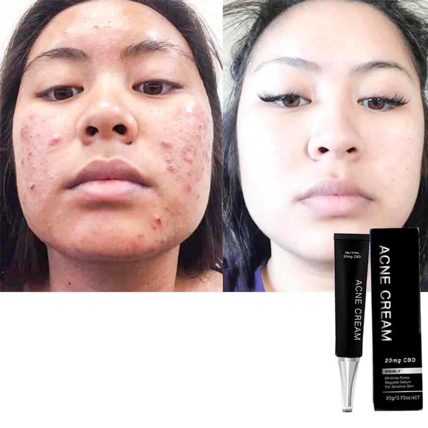 Factory Supply Natural Organic Skin Care Cosmetics For Acne Reduce 
Factory Supply Natural Organic Skin Care Cosmetics For Acne Reduce