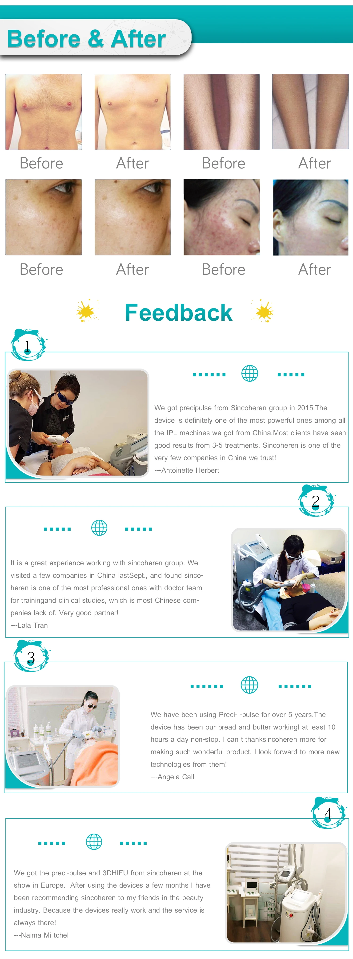 IPL lazer hair removal OPT SPA SHR IPL hair reduction machine