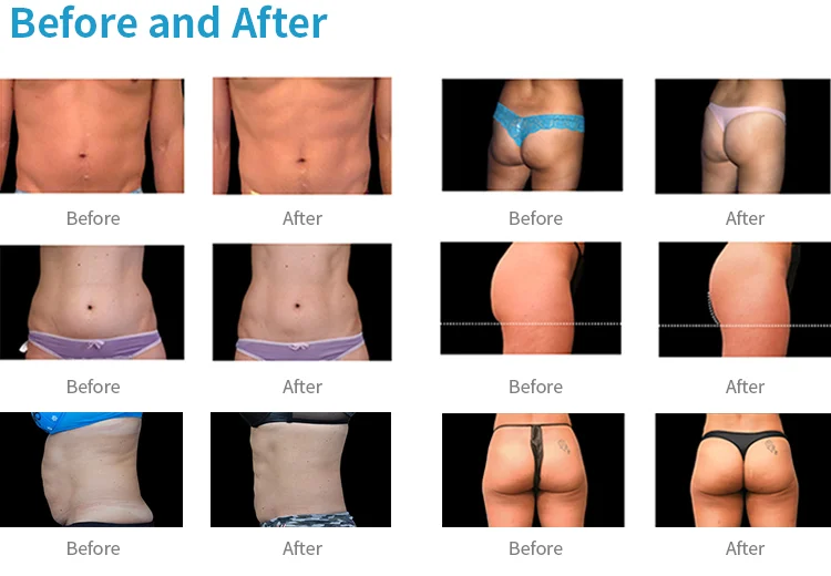 2021 black for building body shape and weight loss Cellusculpt muscle building slim fat removal