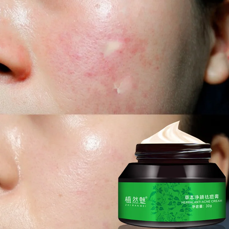 Private Label Moisturizing Whitening Spots Remover Best Anti Acne Cream Whitening Ance Clear Cream, White
Private Label Moisturizing Whitening Spots Remover Best Anti Acne Cream Whitening Ance Clear Cream, White