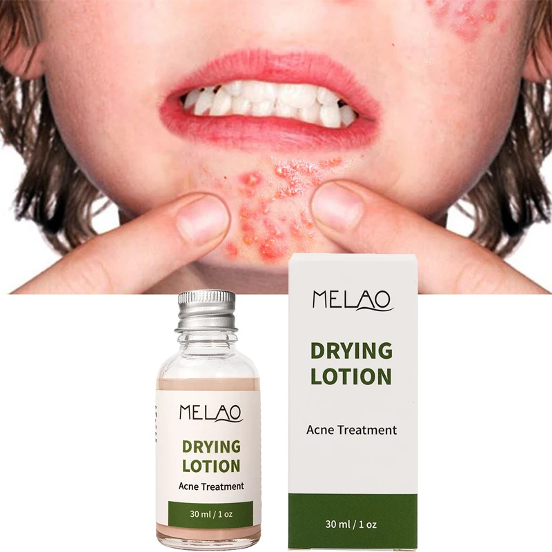 MELAO Acne Pimple Remove Facial Treatment Skin Care Cream Whelk Dark Spot Remover Black Head Smooth Drying Lotion For Young, White
MELAO Acne Pimple Remove Facial Treatment Skin Care Cream Whelk Dark Spot Remover Black Head Smooth Drying Lotion For Young, White