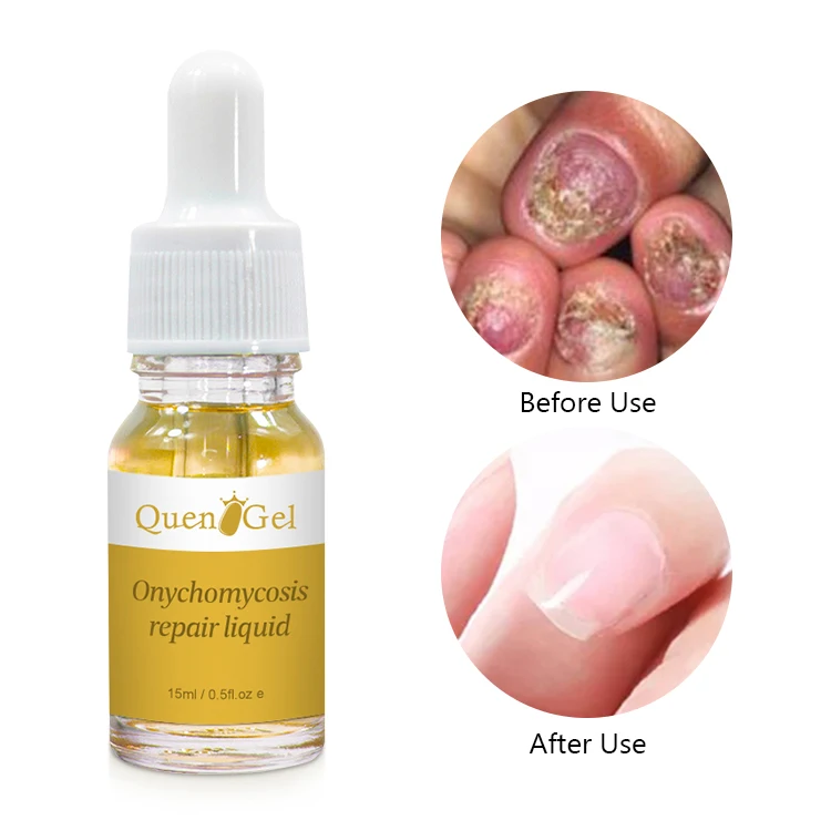 Lanthome Renew Nail Fungal Treatment Liquid 10ml, Fungal Nail Repair Serum With Fungus Treatments
Lanthome Renew Nail Fungal Treatment Liquid 10ml, Fungal Nail Repair Serum With Fungus Treatments