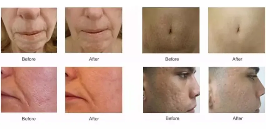 2020 trending product fractional rf microneedle machine for stretch mark acne wrinkle removal