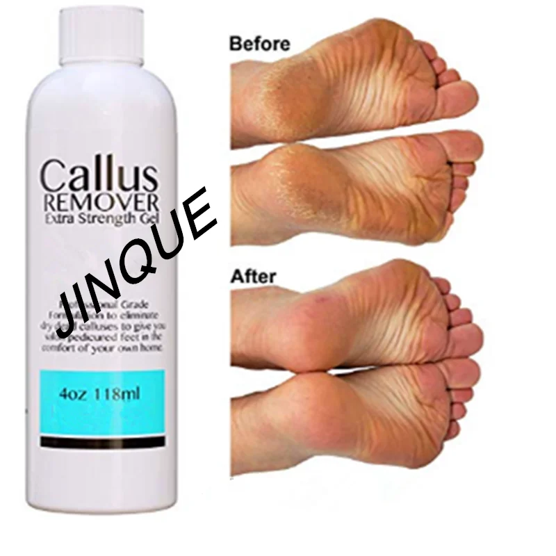 Best foot Callus Remover gel, Callus Eliminator, Liquid & Gel For Corn And Callus On Feet
Best foot Callus Remover gel, Callus Eliminator, Liquid & Gel For Corn And Callus On Feet