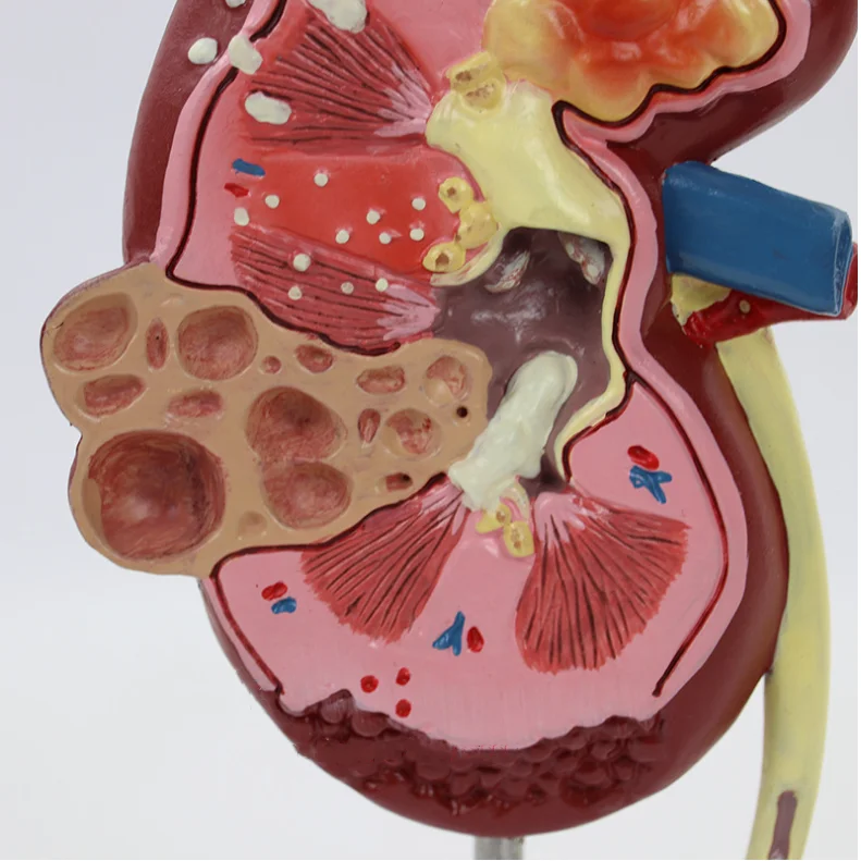 医学教学泌尿系统模型人体解剖学肾脏模型肾脏病变模型