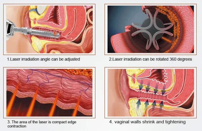 vaginal tightening