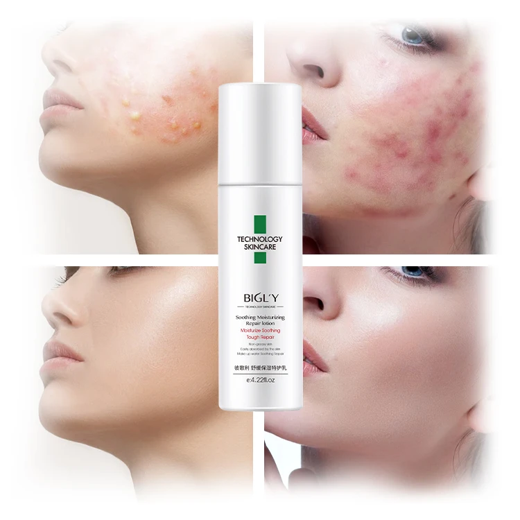 Custom Logo Skin Care Cream Anti Acne Cream Moisturizing Salicylic Acid Acne Cleansing Natural Face Facial Lotion
Custom Logo Skin Care Cream Anti Acne Cream Moisturizing Salicylic Acid Acne Cleansing Natural Face Facial Lotion