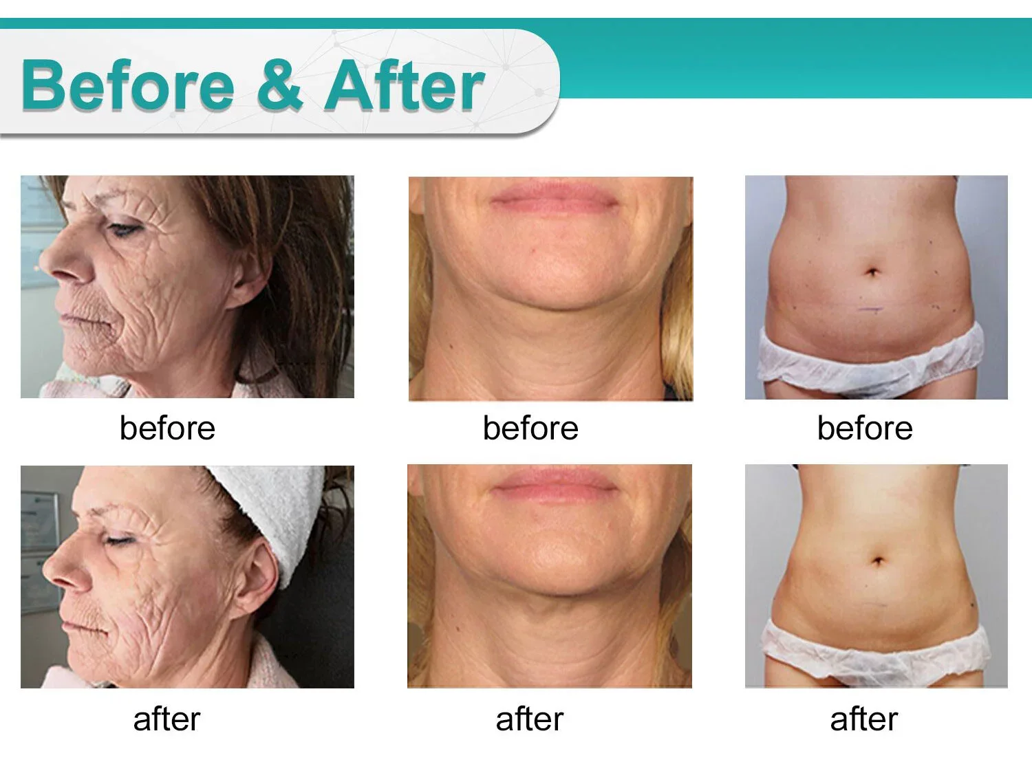 Beijing Sincoheren newest 4D hifu machine for salon beauty equipment for wrinkle removal