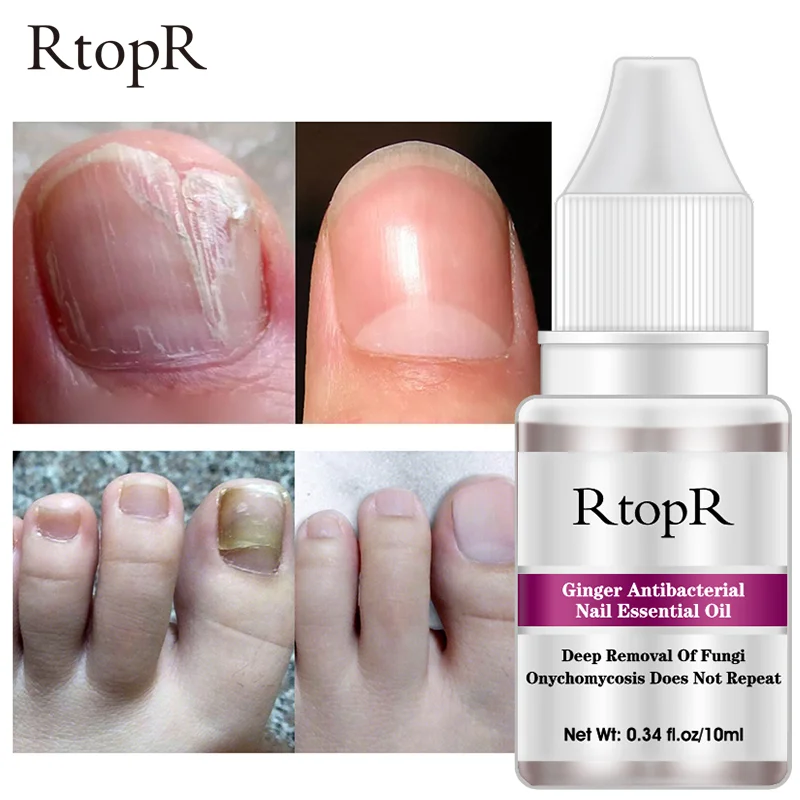 10ml RtopR Ginger Nail Repair Treatment Remove Onychomycosis Toe Nails Nourishing Foot Nail Care
10ml RtopR Ginger Nail Repair Treatment Remove Onychomycosis Toe Nails Nourishing Foot Nail Care