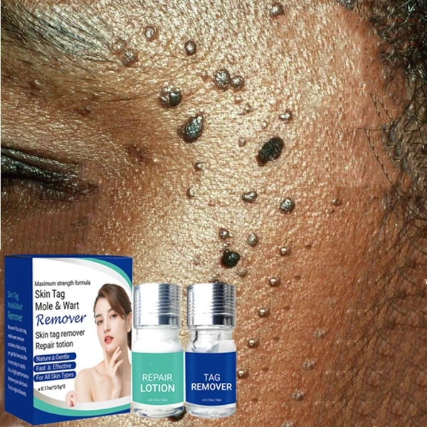 Wart Removal Safe All-natural Pain Acid free Patented Treatmen high frequency skin tag removal serum lotion
Wart Removal Safe All-natural Pain Acid free Patented Treatmen high frequency skin tag removal serum lotion