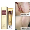LANBENA 30ml Skin Care Dark Spot Whitening Gel Acne Spot Scar Removal Cream