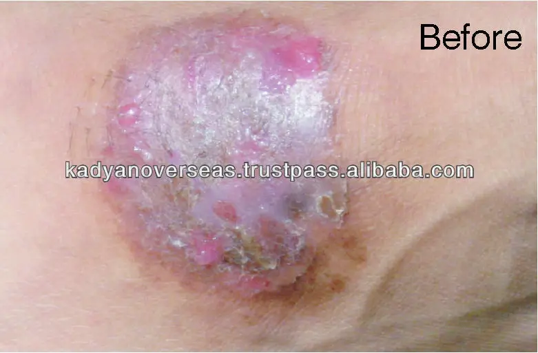 La psoriasis la alimentación a esta enfermedad