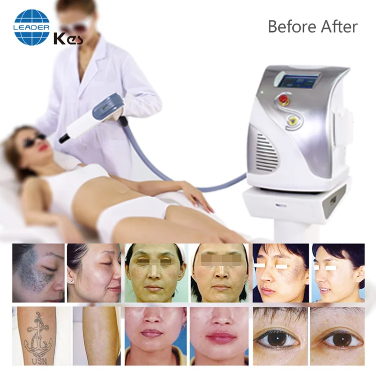 nd yag q-switch laser spot removal/q switched nd yag laser tattoo removal machine 2020/picosecond laser handle tattoo removal ma