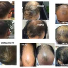US APPROVED hair regrowth laser hair growth comb for alopecia & hair loss