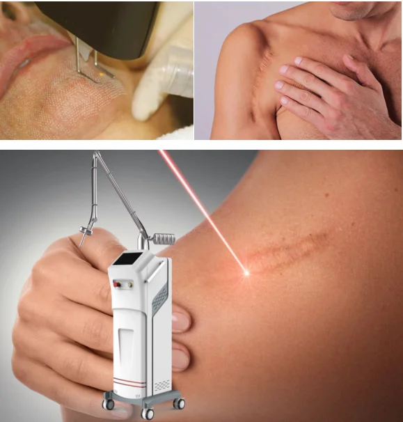 3 Probes CO2 Fractional Laser Machine Medical Beauty Equipment Vaginal Tightening