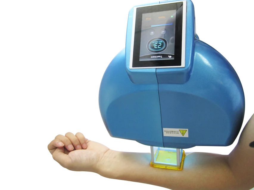 308nm excimer system for vitiligo psoriasis treatment machine, View psoriasis, Peninsula