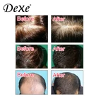 Hair Loss Ginseng Natural Hair Loss