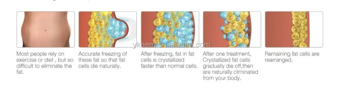  cryolipolysis freezing fat.jpg