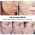 OEM Skin Tea Natural Face Acne Treatment Cream