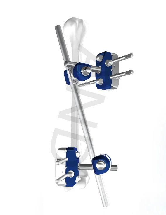 Knee Joint Surgery External Fixation System Buy Knee Joint External
