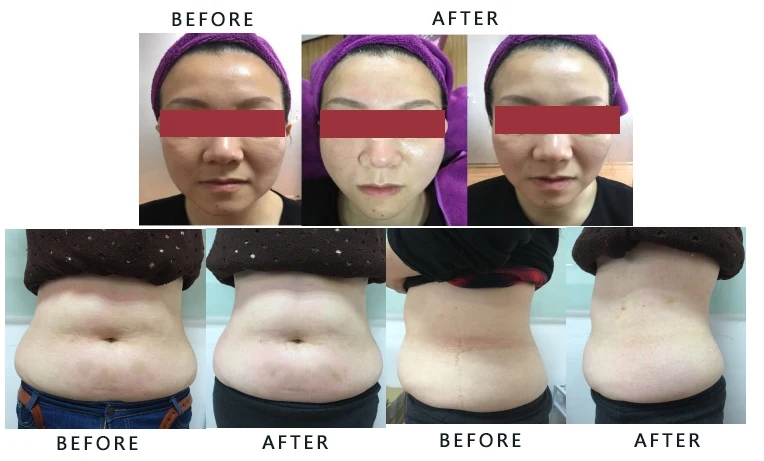 Ultra- slimming and rf body shaping Body Contouring Machine from VANOO LASER