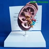Advanced Medical Supplies Human Teaching Diseased Kidney Anatomical Model For Medical School