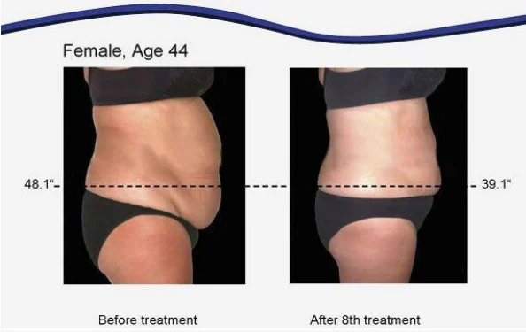 cavitation RF slimming machine/cavitation machine/ultrasonic cavitation rf slimming