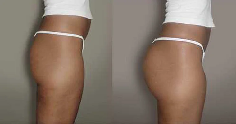 body injection ha filler buttock augmentation.jpg