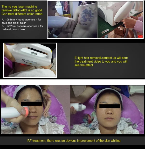 multifunctional ipl machine ipl opt shr E-light rf nd yag laser beauty machine