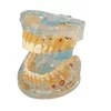 BIX-L1008 Transparent dental pathology model with 14 marks