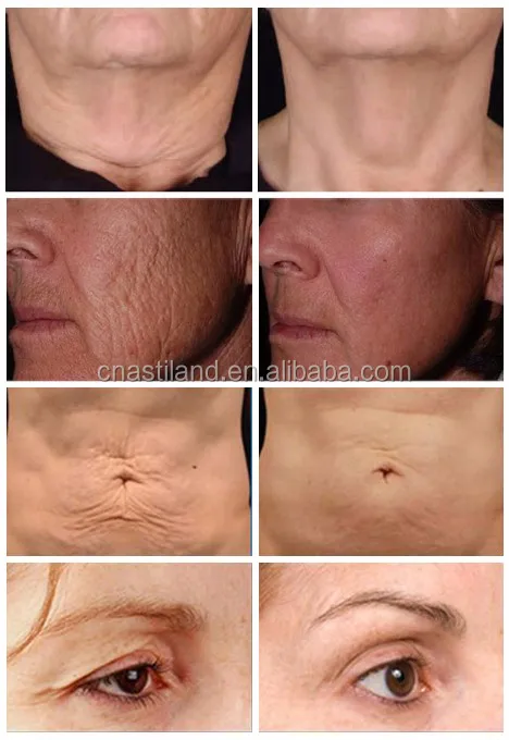 Machine radio frequency facial treatment Microneedle rf