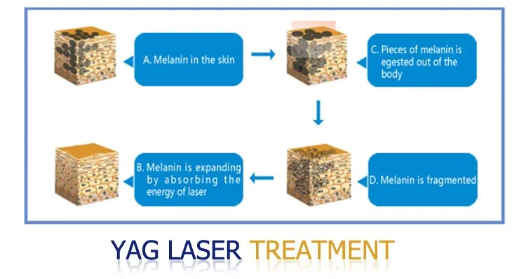 Alta calidad q conmutado nd yag eliminación de tatuajes con láser/láser de máquina de pelar