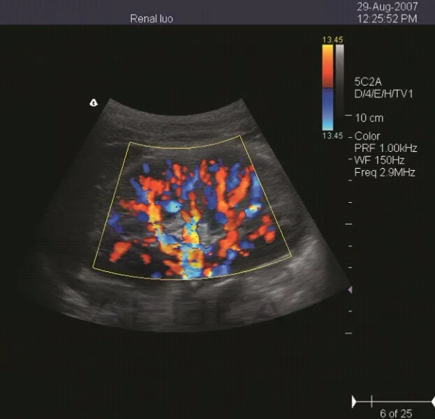 used color doppler ultrasound
