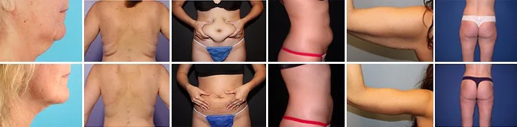cavitation before and after