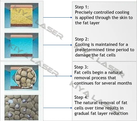 cool sculpting machines.jpg