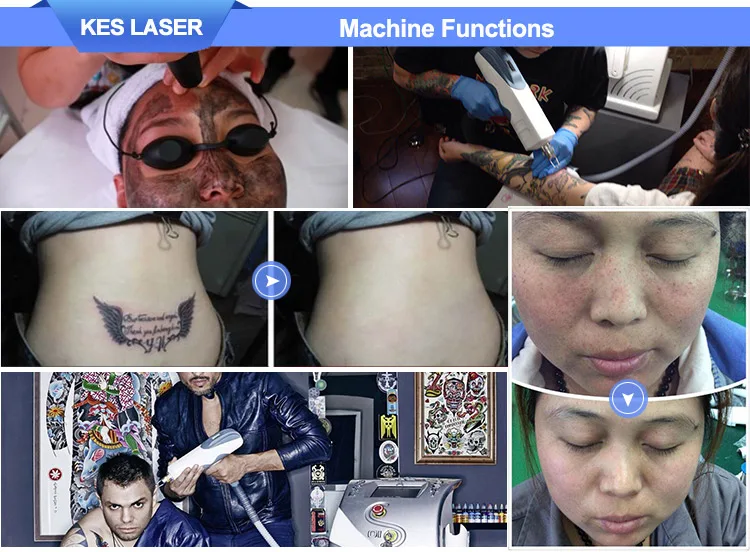 luxury laser tattoo removal machine with 1064nm, 532nm, 755nm, 1320nm and fractional 5 tips