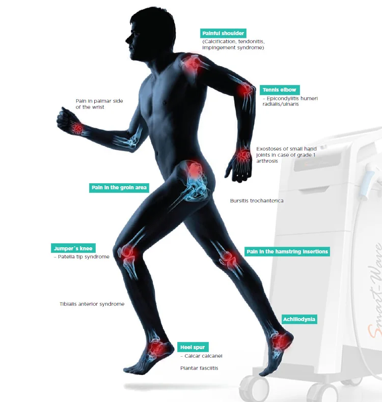 shockwave therapy 6