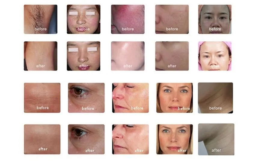 multifunctional ipl machine ipl opt shr E-light rf nd yag laser beauty machine