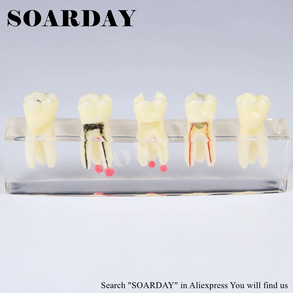 Tooth Root Canal Restoration Model (1)