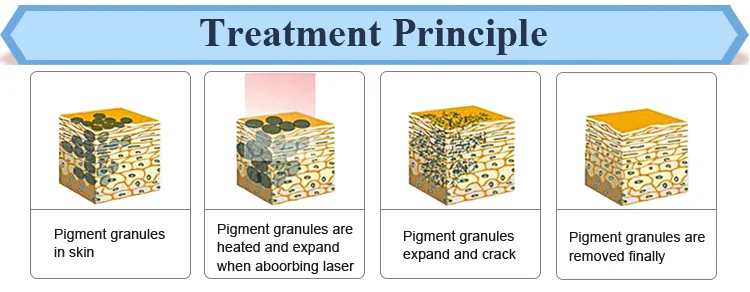 nd yag q-switch laser spot removal/q switched nd yag laser tattoo removal machine 2020/picosecond laser handle tattoo removal ma