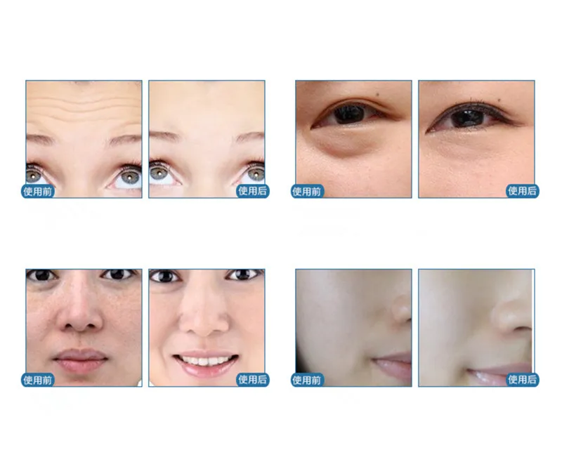 Mesotherapy (13).jpg