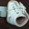 Dennis Splint Shoes for Pediatric Clubfoot Correction