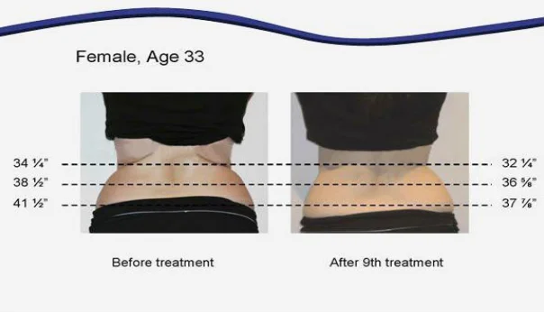 cavitation RF slimming machine/cavitation machine/ultrasonic cavitation rf slimming