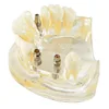/product-detail/azdent-zyr-2005-plastic-dental-implant-model-price-60423024750.html