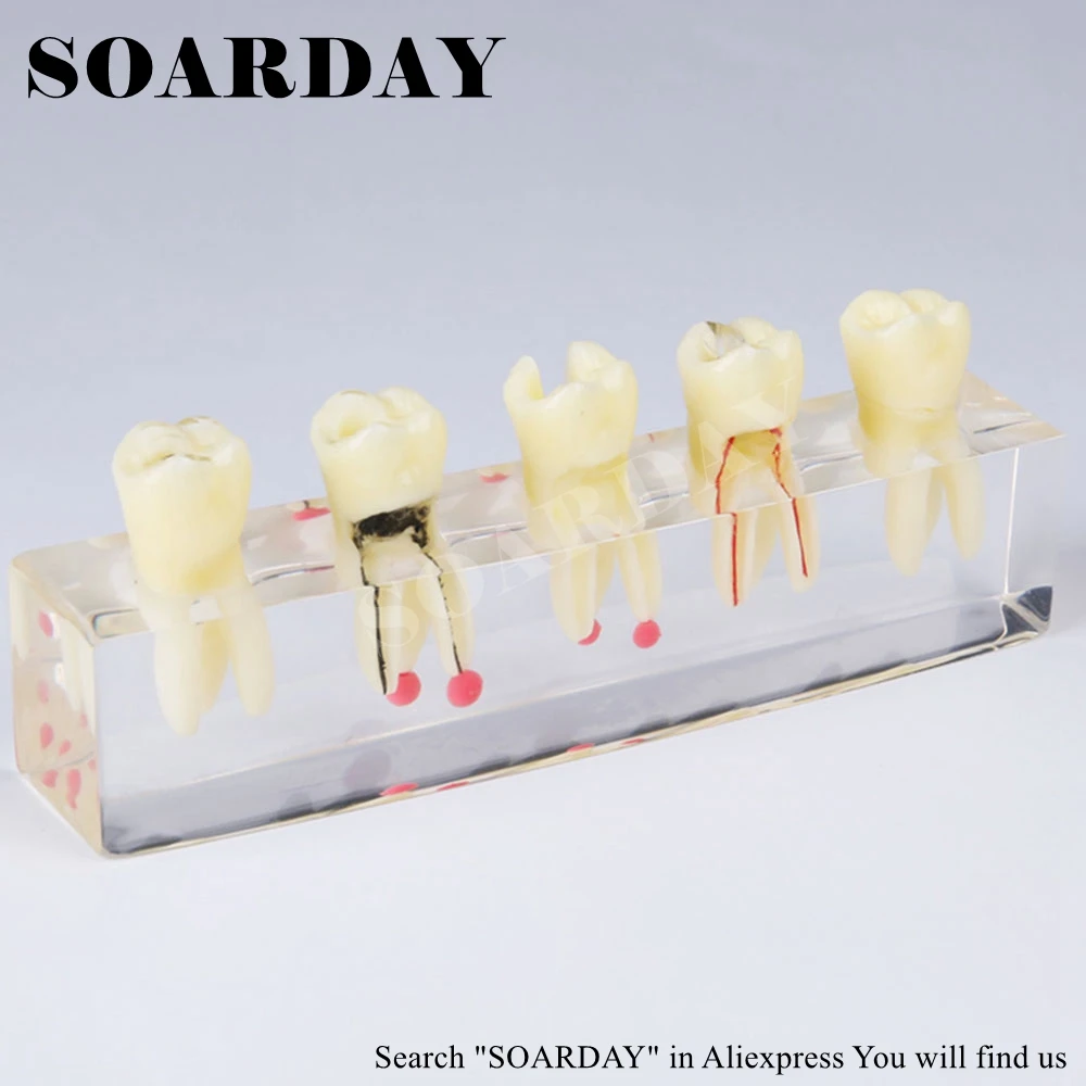 Tooth Root Canal Restoration Model (2)