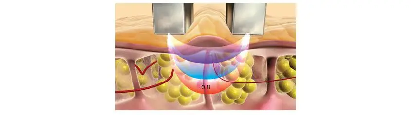 cavitation rf vacuum body machine.jpg