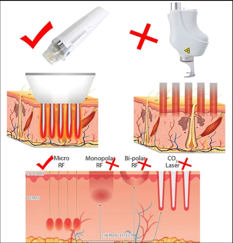 2020 trending product fractional rf microneedle machine for stretch mark acne wrinkle removal